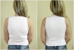 Bra For Back Fat